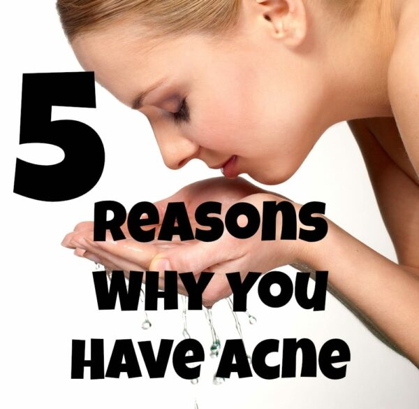 5 Reasons You Suffer From Acne - Lady and the Blog
