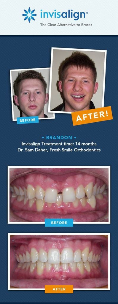 Invisalign Before And After