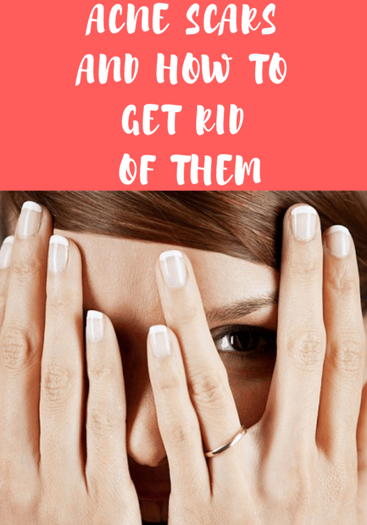How To Get Rid Of Acne Scars: Treatments That Work And At-Home Lotion Options